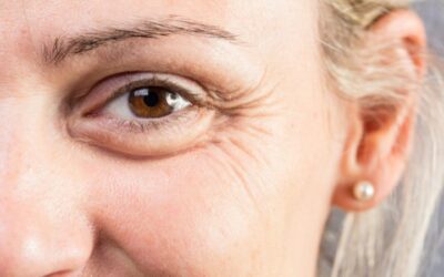 Arrugas por envejecimiento: causas, tratamientos y consejos para combatirlas
